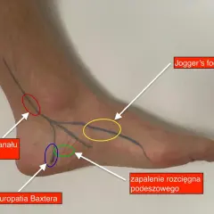Ból pięty u biegacza jak go pokonać i biegać bez kontuzji?