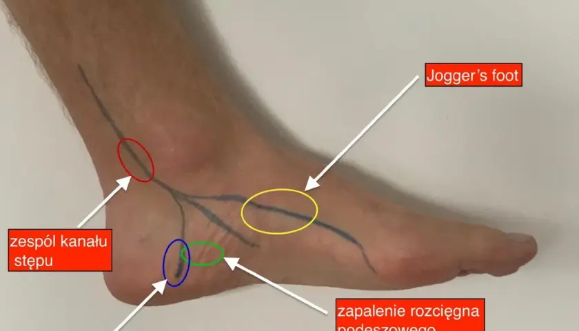 Ból pięty u biegacza jak go pokonać i biegać bez kontuzji?