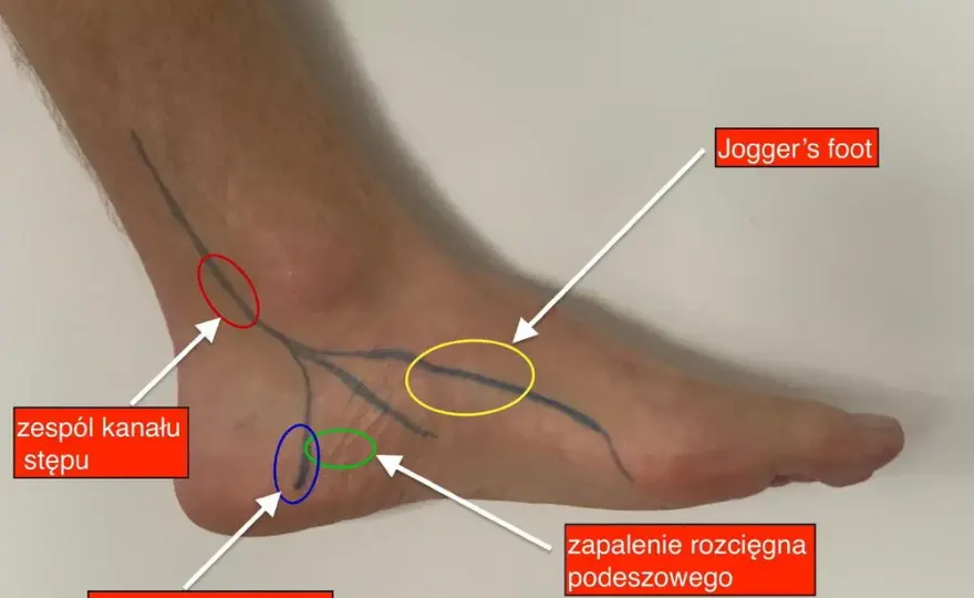 Ból pięty u biegacza jak go pokonać i biegać bez kontuzji?