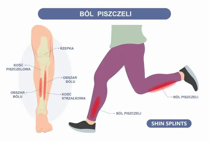 biegacz ból piszczeli przyczyny