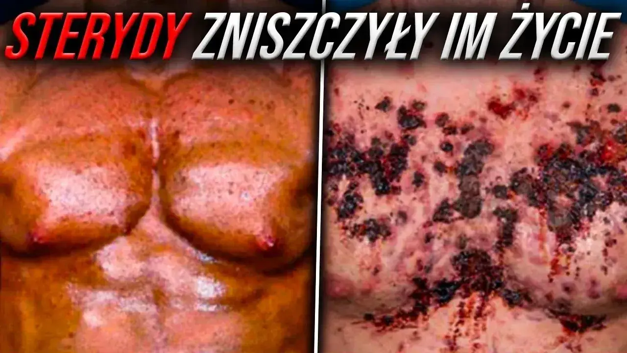 Negatywne skutki sterydów na organizm człowieka grafika