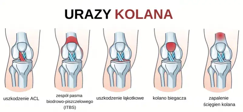 Infografika rodzaje bólu kolana u biegaczy, lokalizacja bólu kolana